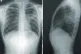 X-ray of lungs CDC / Creative Commons